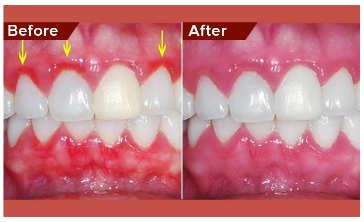 Înainte și după tratament gingival