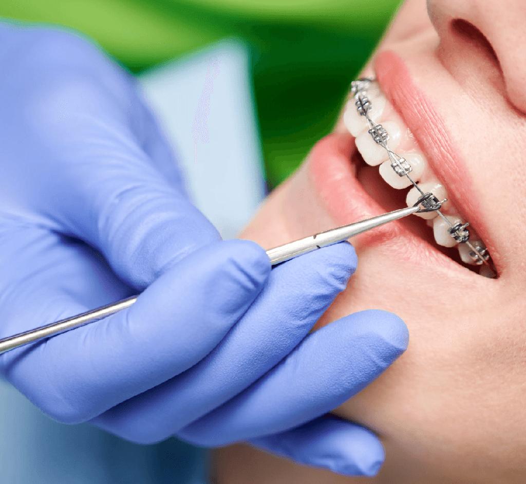 Aparat dentar metalic