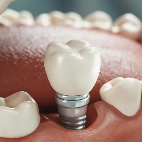 Restaurare dentară fixă