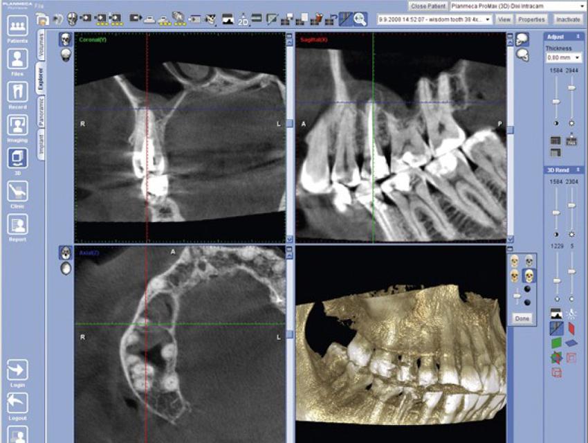 CBCT pentru evaluarea osului