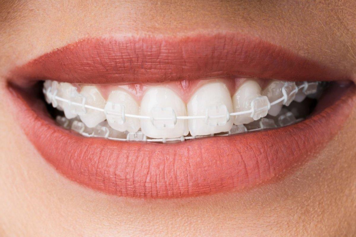 Aparat dentar ceramic
