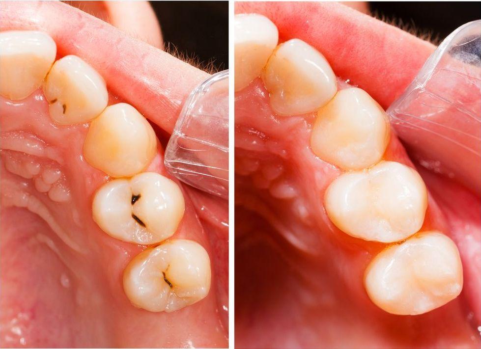 Fluorizare și prevenția cariilor