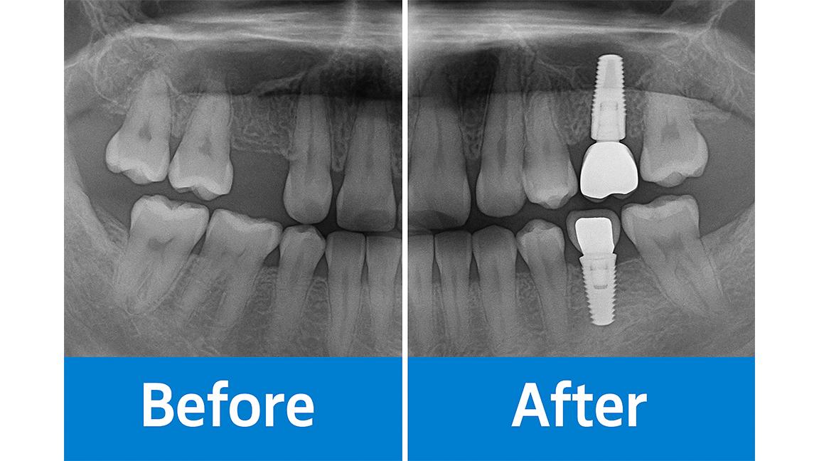 Adiție osoasă și implant