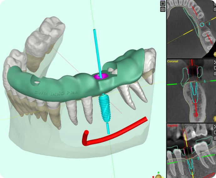Planificare implant dentar