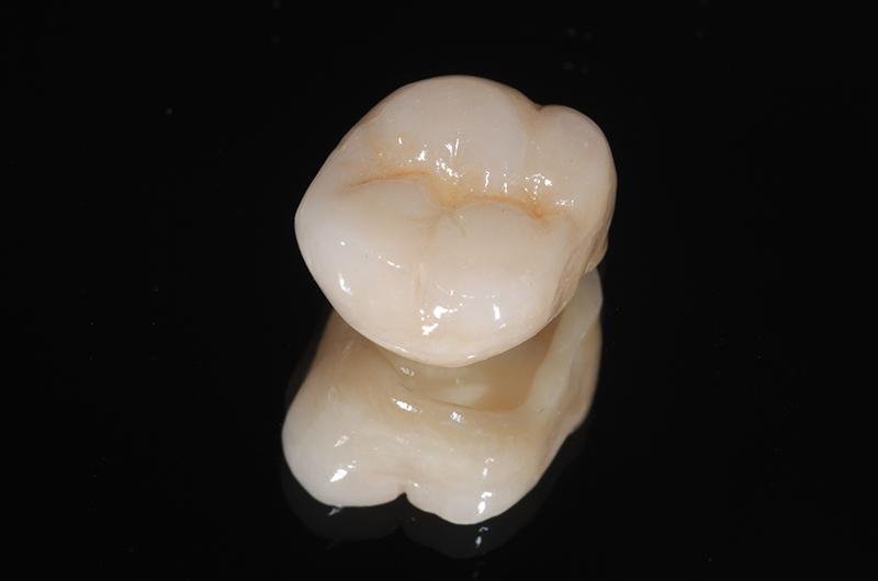 Coroană integral ceramică