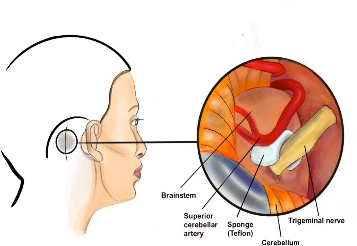 Ilustrație medicală neurologie